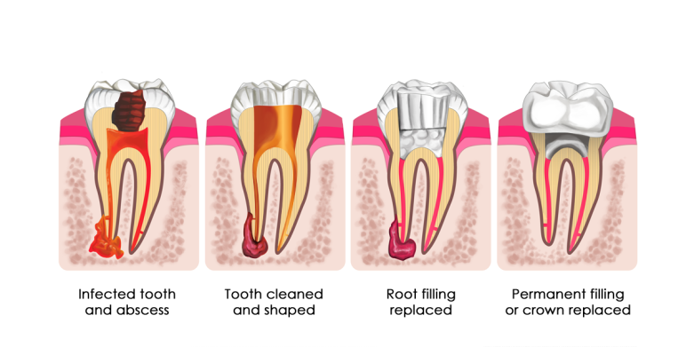 Root Canal Process